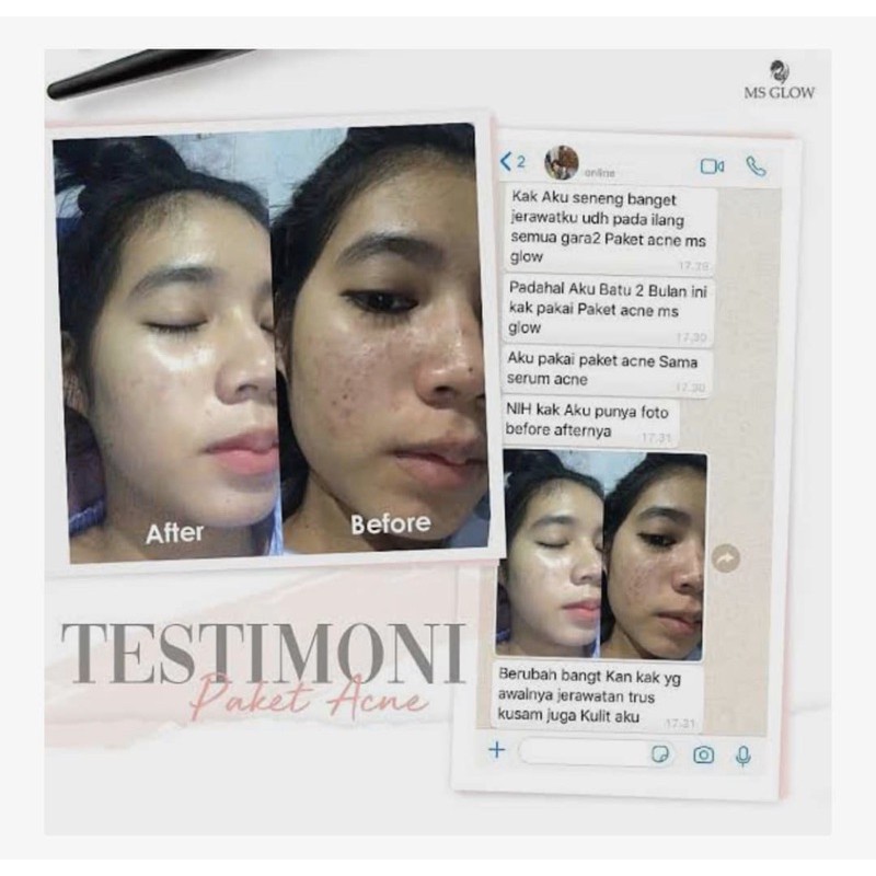 PAKET WAJAH ACNE UNTUK KULIT BERJERAWAT MSGLOW TERLARIS