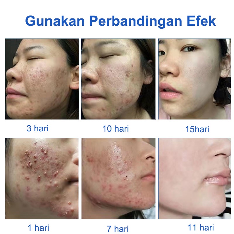 Serum Acne Obat Jerawat Obat Totol Jerawat 30g Herbal Obat Jerawat Dan Bekas Jerawat Obat Jerawat Dan Bekas Jerawat Paling Ampuh