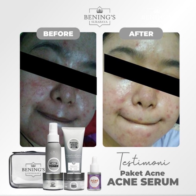 BENING'S PAKET ACNE | MENGATASI JERAWAT, BRUNTUSAN &amp; MENCERAHKAN KULIT