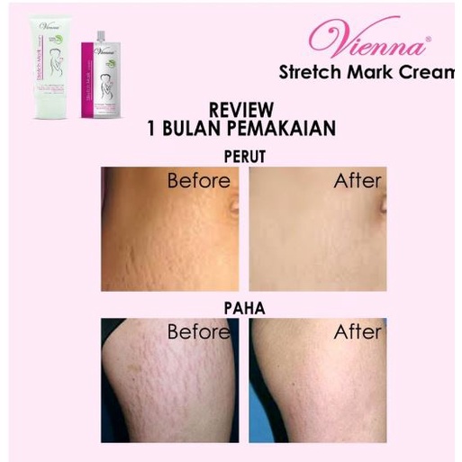 VIENNA STRETCHMARK CREAM CICA+ SOLUTION ORIGINAL - PENGHILANG STRETCH MARK PERUT PAHA