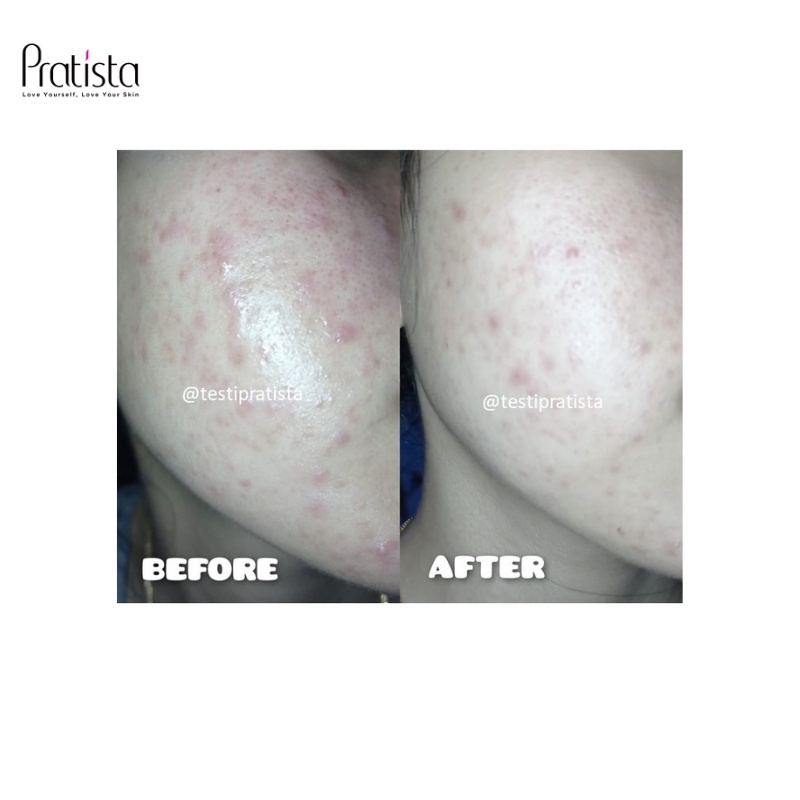 Spray Wajah Pratista Calming Spray Face Mist Toner Spray Wajah Anti Jerawat Dan Beruntusan Pratista Skincare Ori PS13
