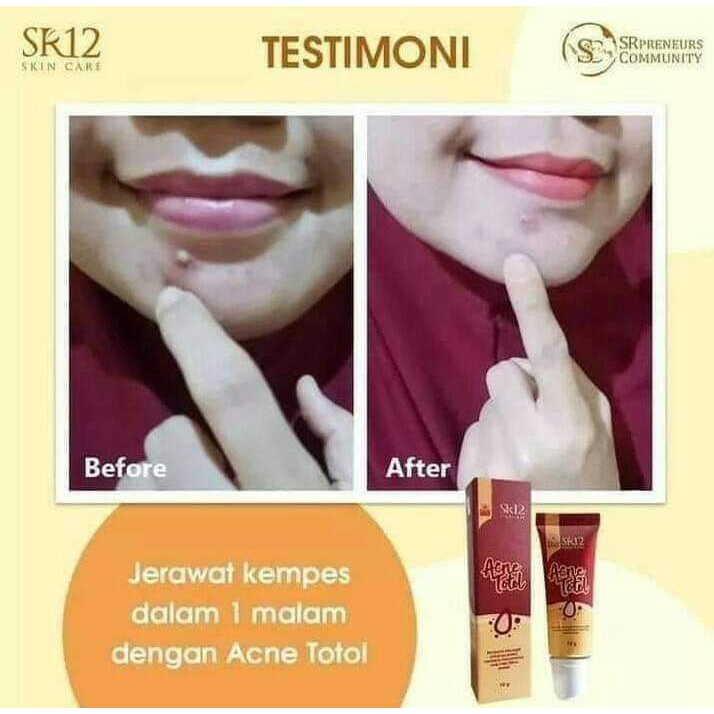 Acene Totol SR12 SR 12 Cream Krim Obat Oles Perawatan Penghilang Pembersih Jerawat Dan Bekas Jerawat BPOM Ampuh