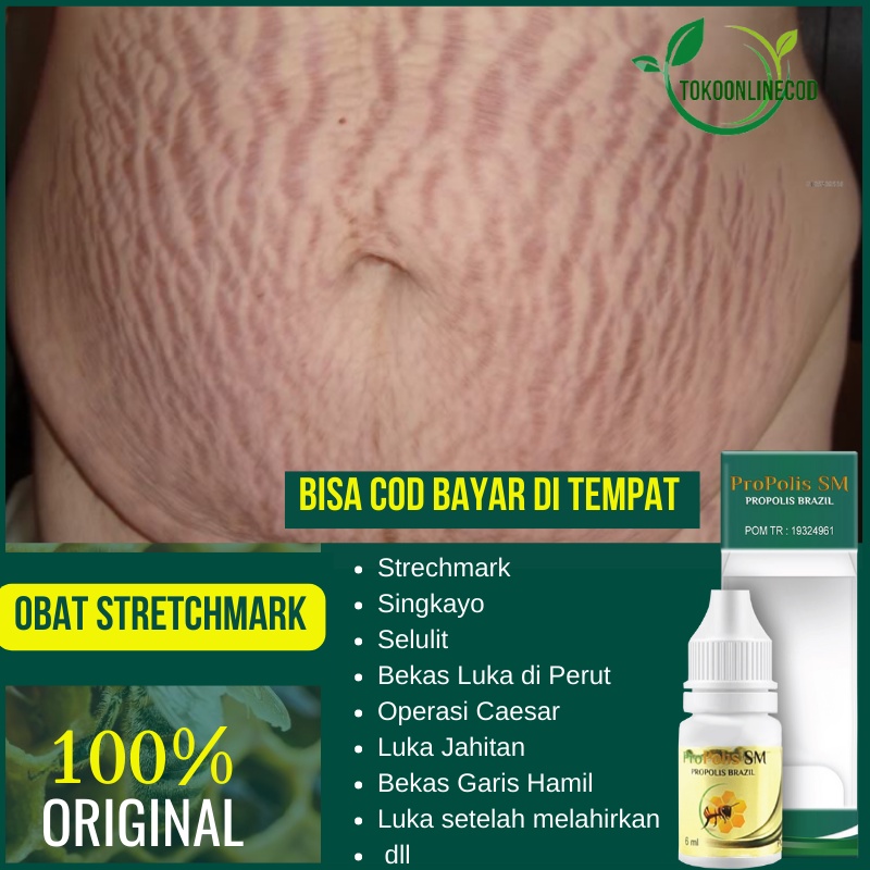 Obat Strechmark, Penghilang Strechmark, Bekas Luka di Perut, Singkayo, Selulit, Gurat Peregangan di 