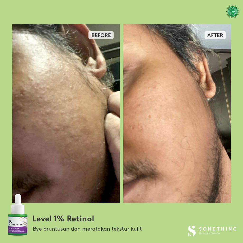 Somethinc Level 1% Retinol Penghilang Jerawat Komedo Kerutan Bruntusan Bekas Luka Wajah