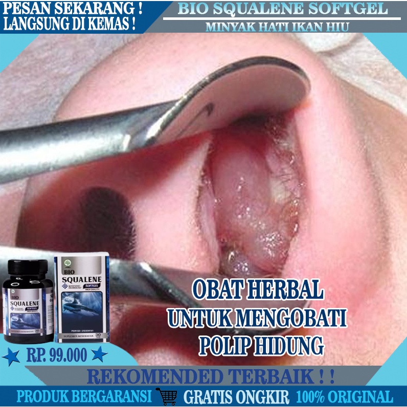 Obat Polip Hidung, Obat Benjolan Di Dalam Hidung, Herbal Polip Hidung, Obat Penyakit Polip Hidung, O