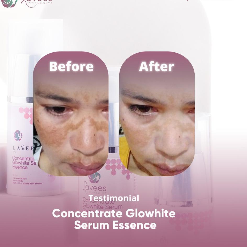 [CODEES14] Lavees Cosmedics - Concentrate Glowhite Serum Essence [Serum Flek & Melasma] Pasti dikiri