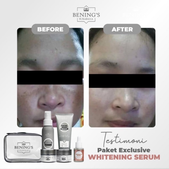 BENING'S PAKET EXCLUSIVE | MENGATASI FLEK, MELASMA &amp; MENCERAHKAN KULIT