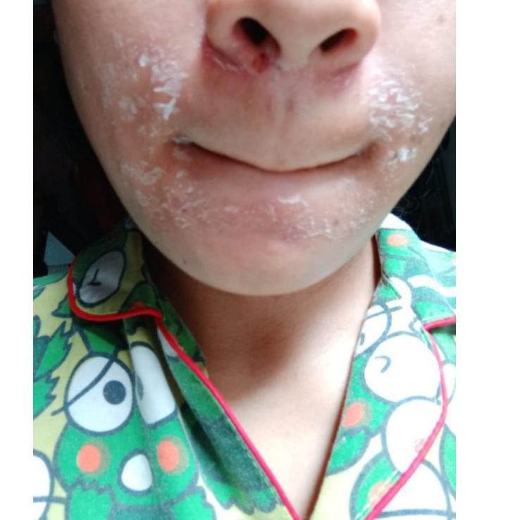 Nirmala skincare paket jerawat / cream jerawat strong dosis tinggi/pemutih wajah