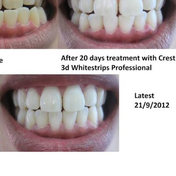 ♥ Oral B Whitestrips 3D Pemutih Gigi ➭