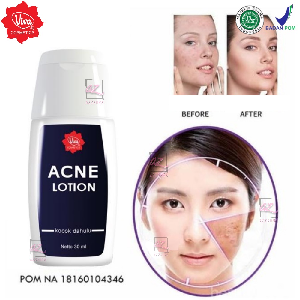 Viva Acne Lotion 30ml | Lotion Triple Action