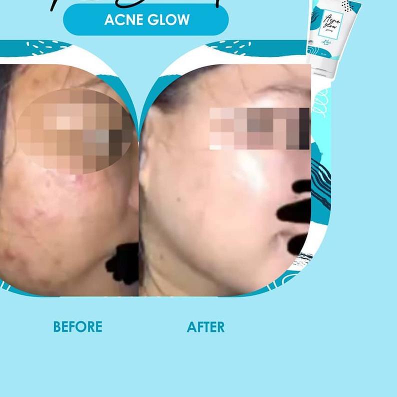 ☼ GLAFIDSYA SKIN ECERAN PAKET ACNE GLOWING GLAFIDSYA OFFICIAL STORE ➾