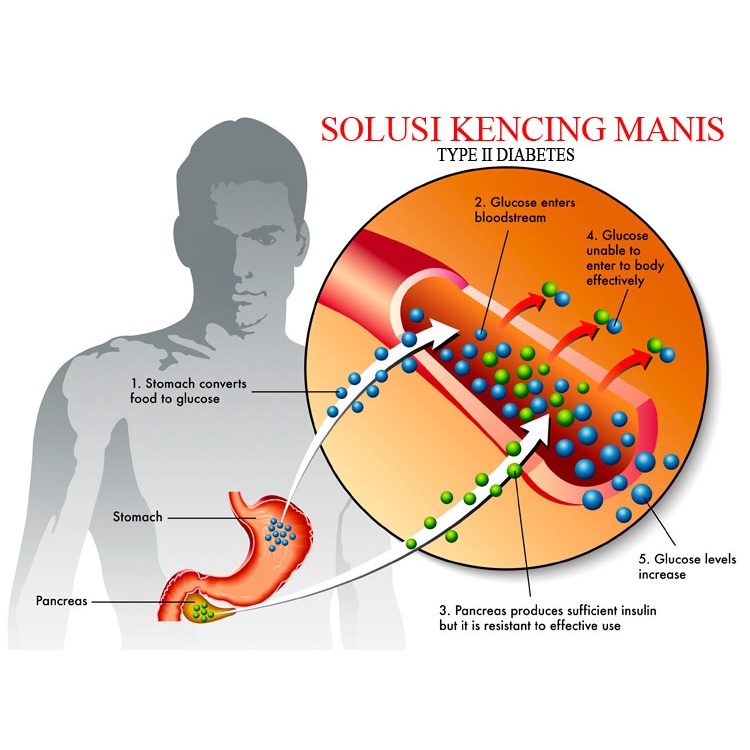 

Solusi Kencing Manis Kapsul Herbal Sehat 100% Original Herbal/Obat herbal atasi tanpa operasi/Obat herbal asli/obat herbal tanpa bahan kimia/obat herbal bpom/obat herbal langsung pabrik