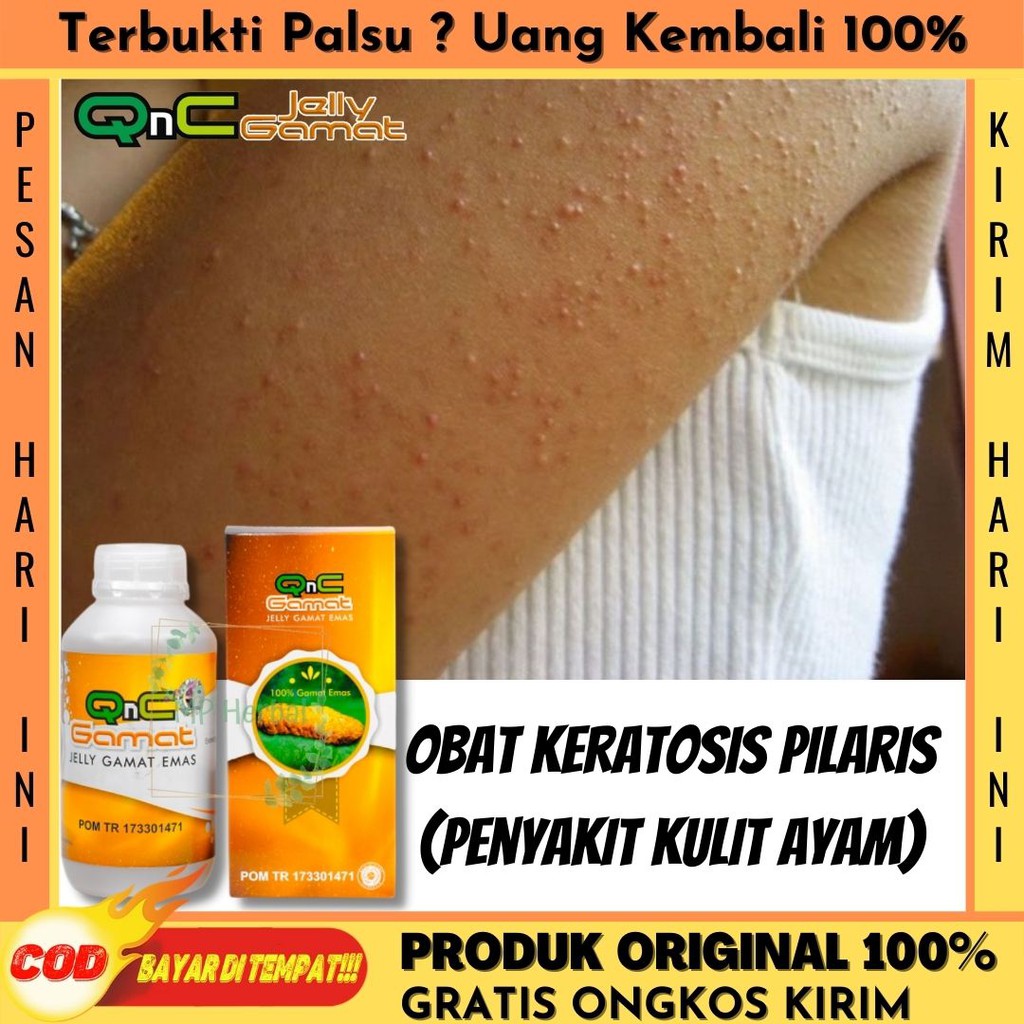 Obat Keratosis Anak dan Dewasa