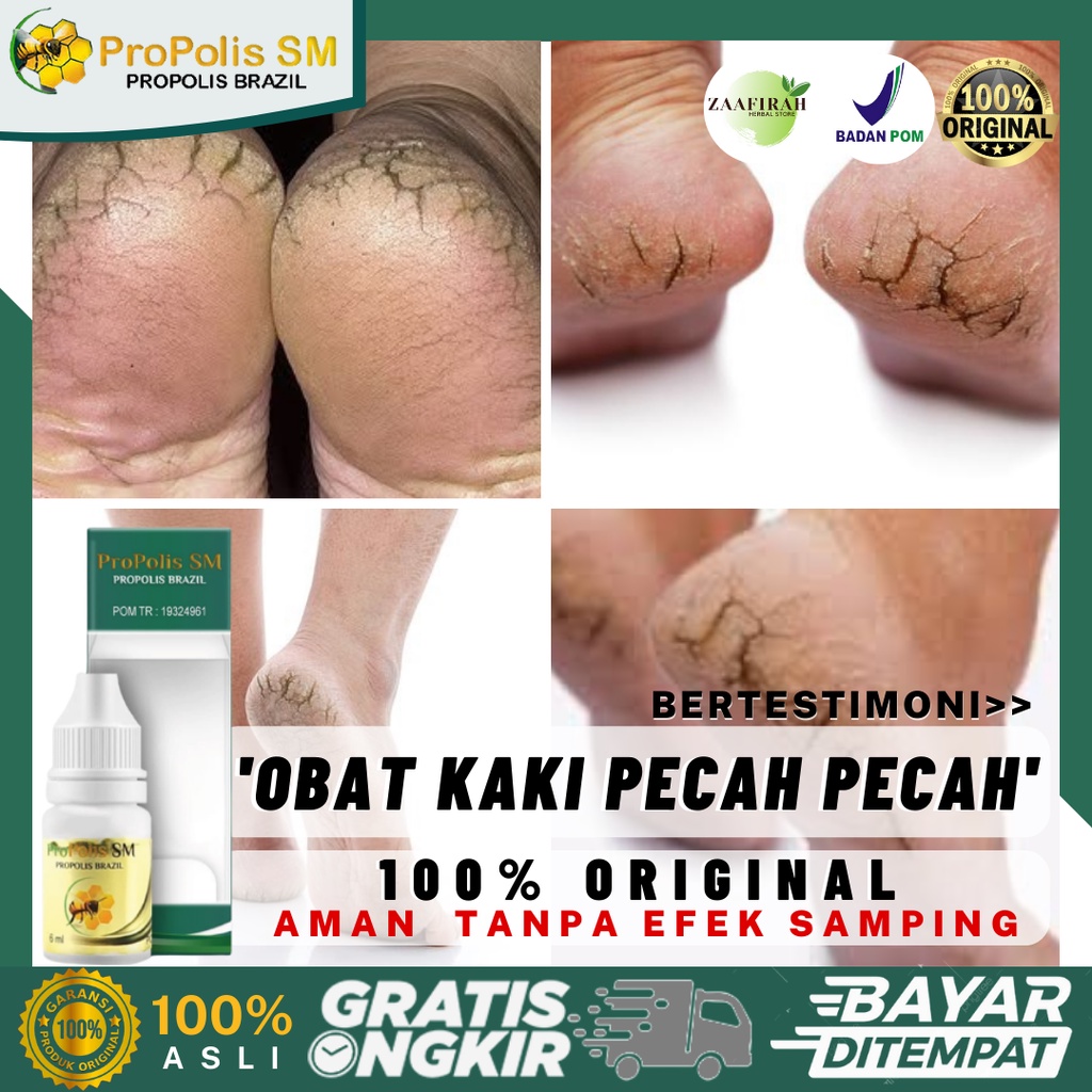 Obat Oles Kaki Pecah Pecah - Tumit Kaki Retak - Telapak Kaki Kering Parah - Tumit Kasar Bersisik - R