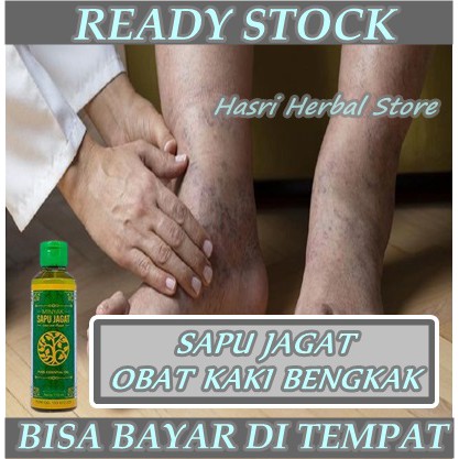 Obat Kaki Bengkak - Pengempes Kaki Bengkak Karena Diabetes, Gula Darah Naik, Asam Urat, Jantung