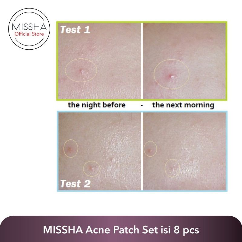 [BPOM] ACNE PATCH BY MISSHA ISI 12PATCH OBAT JERAWAT PATCH JERAWAT OBAT TOTOL JERAWAT STIKER JERAWAT ACNE SPOT TREATMENT JERAWAT OBAT TOTOL JERAWAT PENUTUP JERAWAT PENGEMPES JERAWAT TEMPELAN JERAWAT MASKER JERAWAT