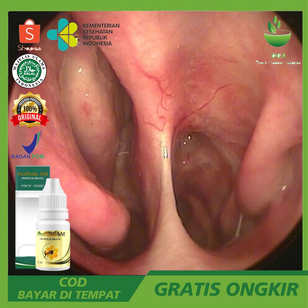 Obat Polip Hidung Sinusitis Pilek Menahun Alergi Hidung Gurah Hidung