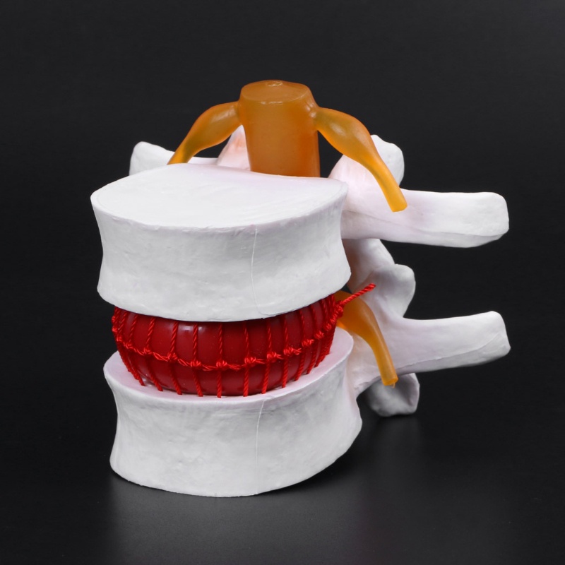 Mary Human Anaatomical Lumbar Disc Model Herniasi Alat Bantu Belajar Medis Instrumen Anatomi
