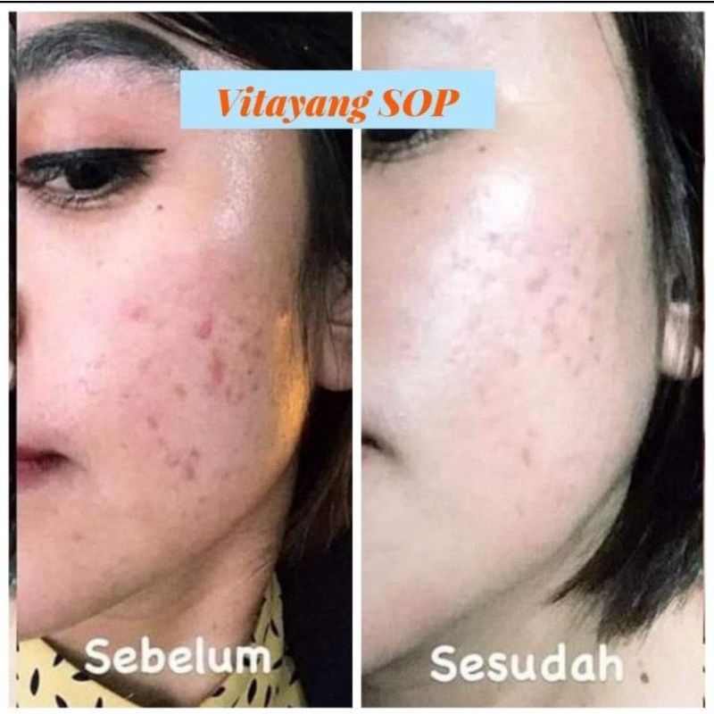 Vitayang SOP Salmon Ovary Peptide Minuman Kecantikan dari Jepan Menghilangkan Flek jerawat Mencerahkan wajah Suplemen Kesehatan Collagen Original KK Indonesia