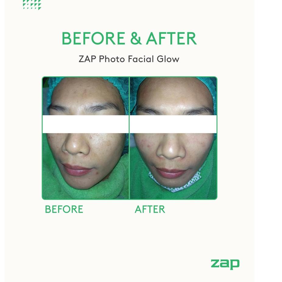Lagi Tren.. [Khusus ZAP Clinic Surabaya Bukit Darmo Opening] 2x Photo Facial Glow