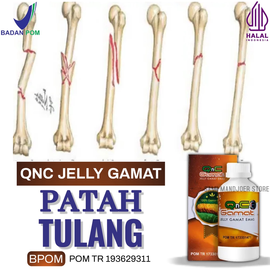 Obat Patah Tulang Akibat Jatuh Atau Kecelakaan, Tulang Retak, Patah Tulang, Tulang Remuk, Tulang Ker