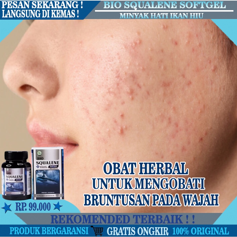 Obat Gatal Bruntusan Wajah, Obat Bruntusan Biang Keringat, Obat Bruntusan di Jidat, Obat Untuk Mengh