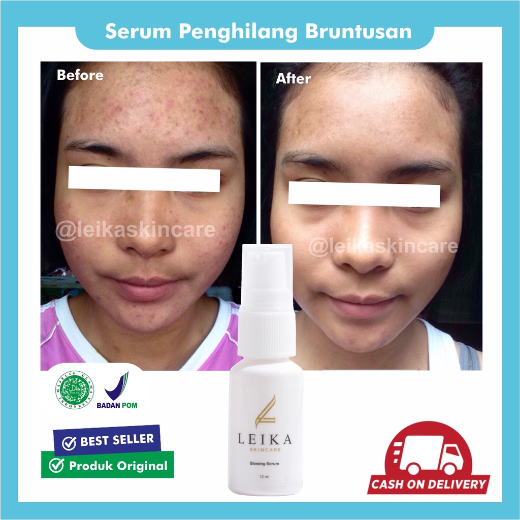 Serum Bruntusan Ampuh Serum Menghilangkan Bruntusan Perawatan Wajah Serum Jerawat Dan Bruntusan Seru