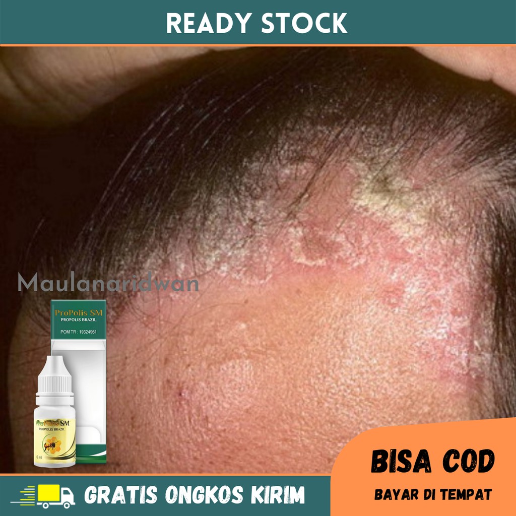 Obat Kulit Kepala Berkerak, Gatal Kulit Kepala, Psoriasis, Kulit Kepala Bersisik, Kering, Infeksi Ja