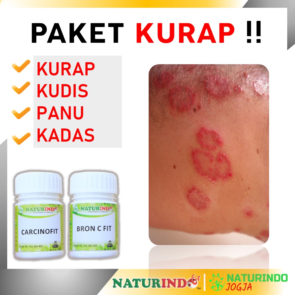 Jual Obat Biduran Gatal Gatal Kulit Alergi Dingin Gatel Ampuh Bintik Merah Bentol Kulit Panu Kurap Kudis Kadas Eksim Obat Gatal Ampuh Jamur Kulit Herbal Naturindo Hepatifit Bpom Halal Ampuh Gatel Gatel