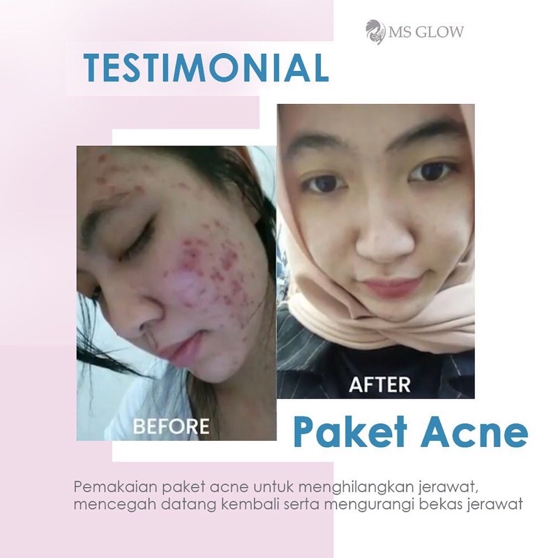 Ms Glow Paket Wajah Acne Original/whitening/luminous/ultimate