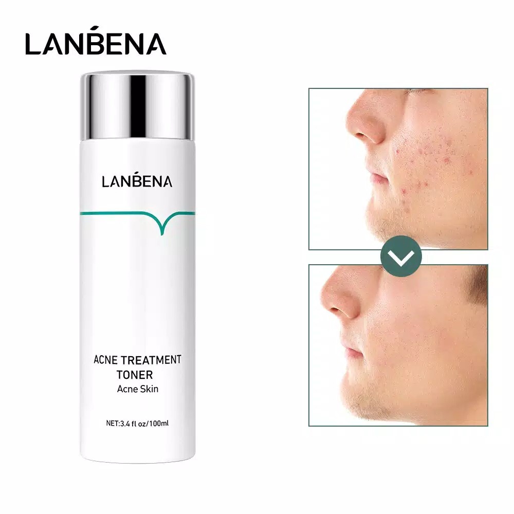 LANBENA Toner Acne Anti Jerawat Treatment Untuk Memperbaiki Kulit ORI