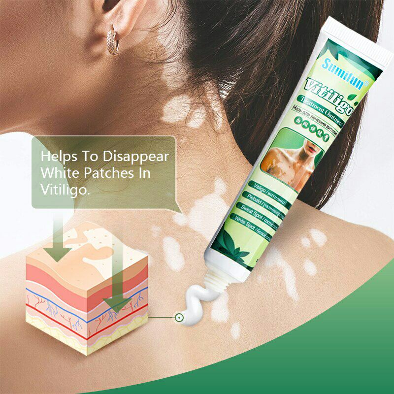 Sumifun Cream Salep Vitiligo Antibakteri