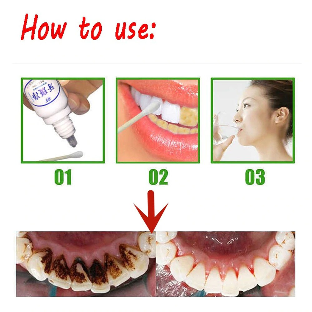 [ BISA COD ] YABANJING PEMBERSIH &amp; PERONTOK KARANG GIGI, PEMUTIH GIGI KUNING PERMANEN INSTANT DAN AMAN