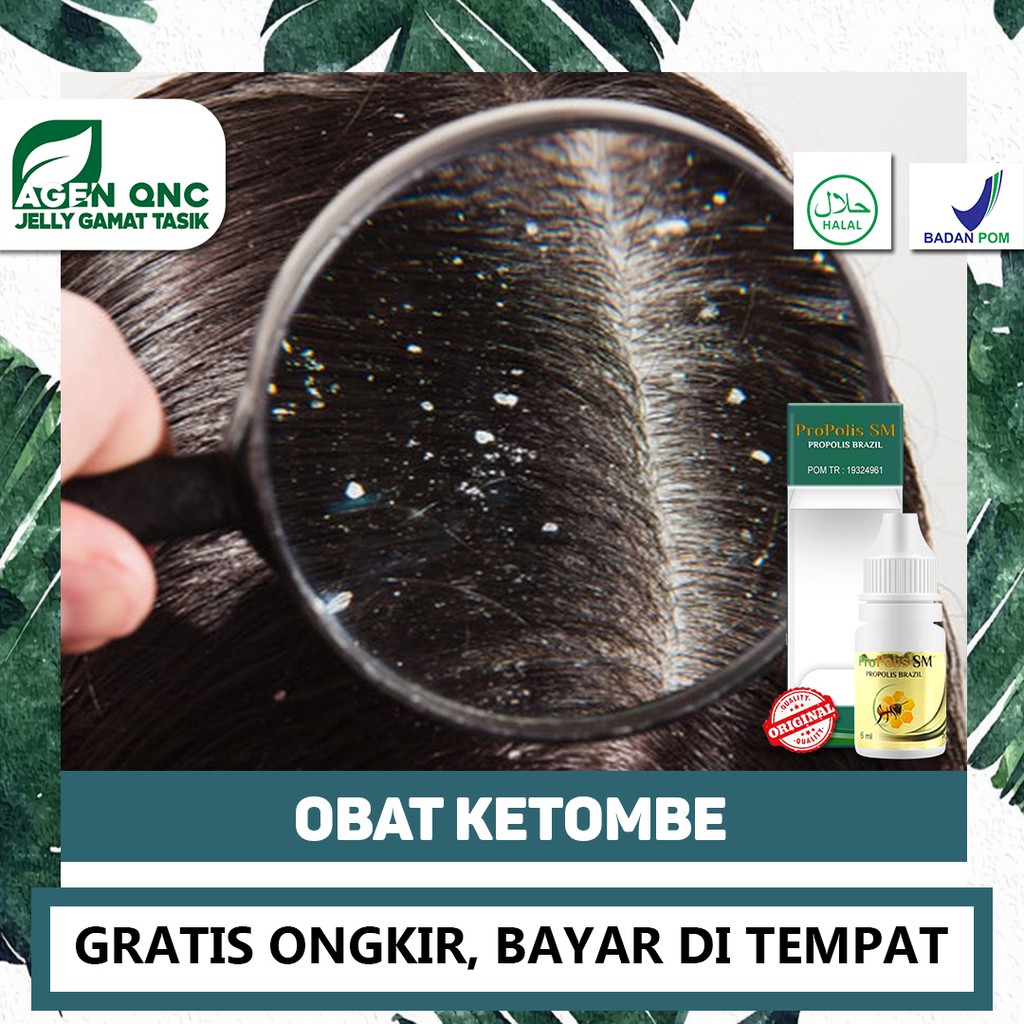 Obat Ketombe, Ketombe Kering, Ketombe Basah, Gatal Ketombe di Kepala Terlaris Propolis Sm