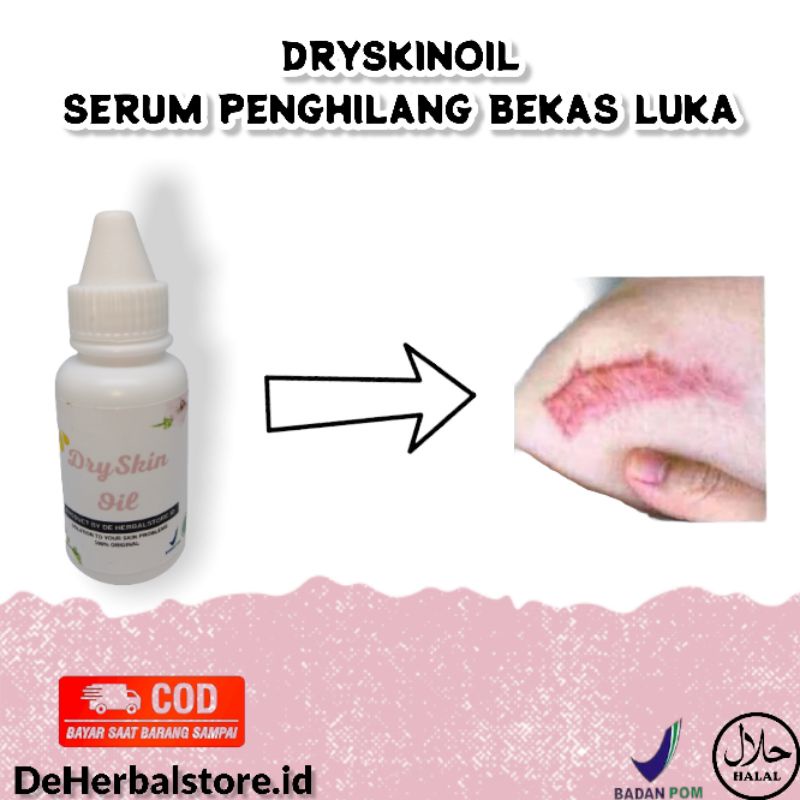 DRYSKINOIL | Penghilang Bekas Luka,Strechmark,Keloid, Jerawatan Badan,Dan Flek Hitam(Ketiak,Selakang