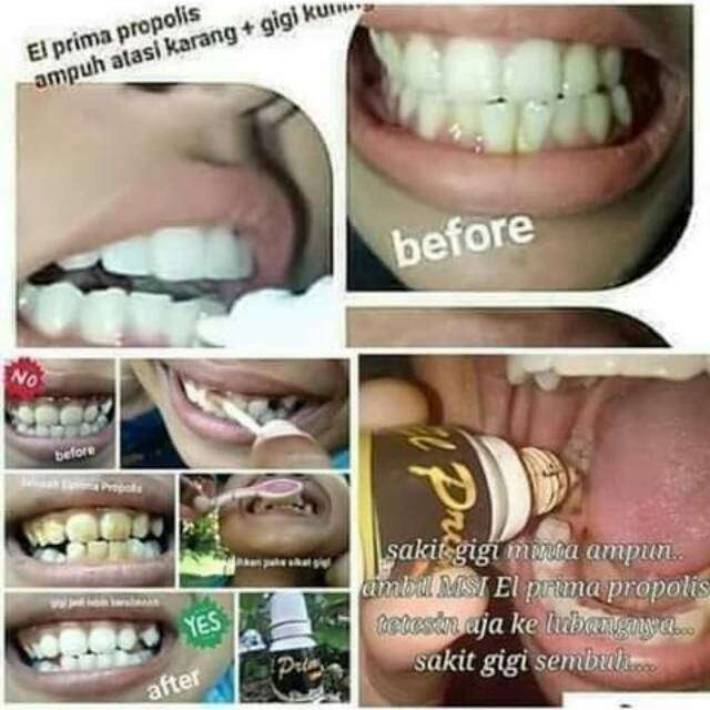 

El prima propolis