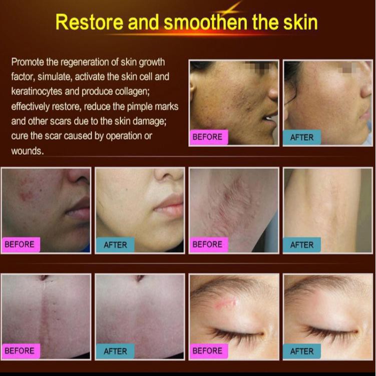 KELOID  /  PORE PENGHILANG PORI PORI / 24k gold / KELOID / STRECTMARK - BREYLEE COLLAGEN  COLLAGEN ANTI PENUAAN ORI