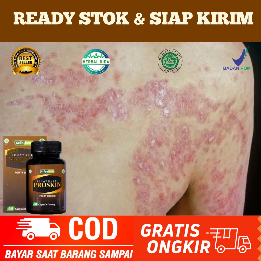 PROSKIN 100% ORIGINAL BPOM, Obat Ruam Kulit, Obat Kulit Gatal Jerawat Ruam, Obat Ruam Merah, Penghil