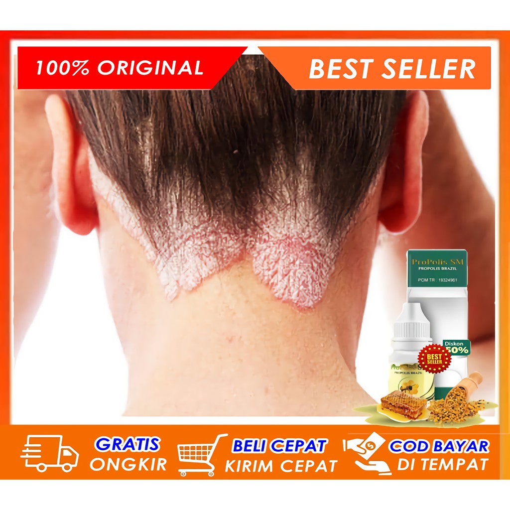 Obat Psoriasis di Kepala, Penghilang Psoriasis Terlaris, Psoriasis di Wajah, Badan, Tangan, Kaki