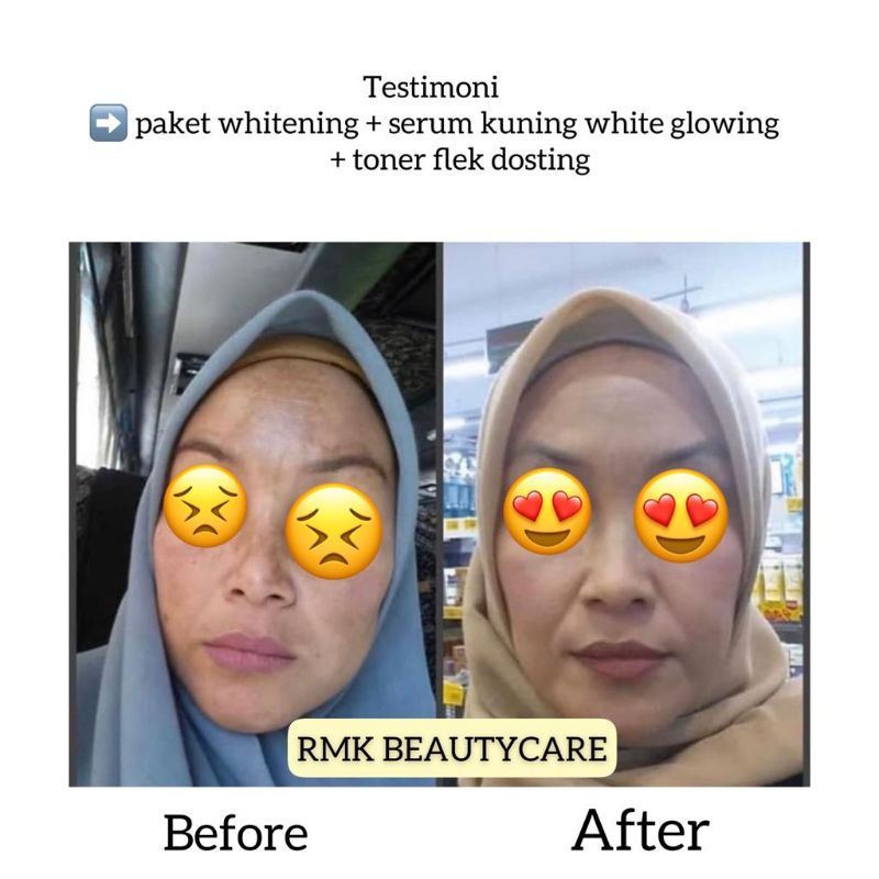 salep flek dosting / salep flek bandel / toner flek dosting / cream flek wajah susah putih / fleksol flek solution rmk