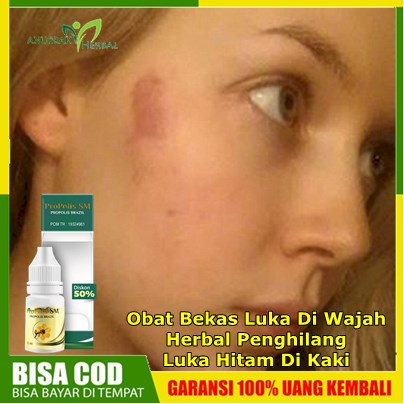 Obat Bekas Luka Di Wajah, Herbal Penghilang Luka Hitam, Koreng, Bakar, Jahitan, Luka Lama Di kaki / 