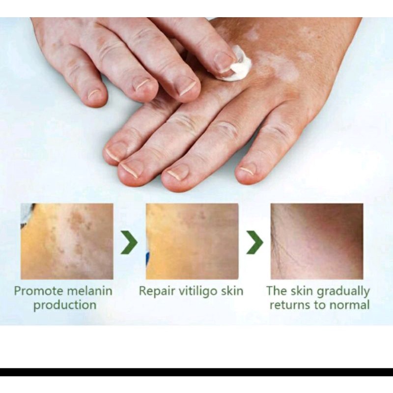 Sumifun Cream Salep Vitiligo Antibakteri