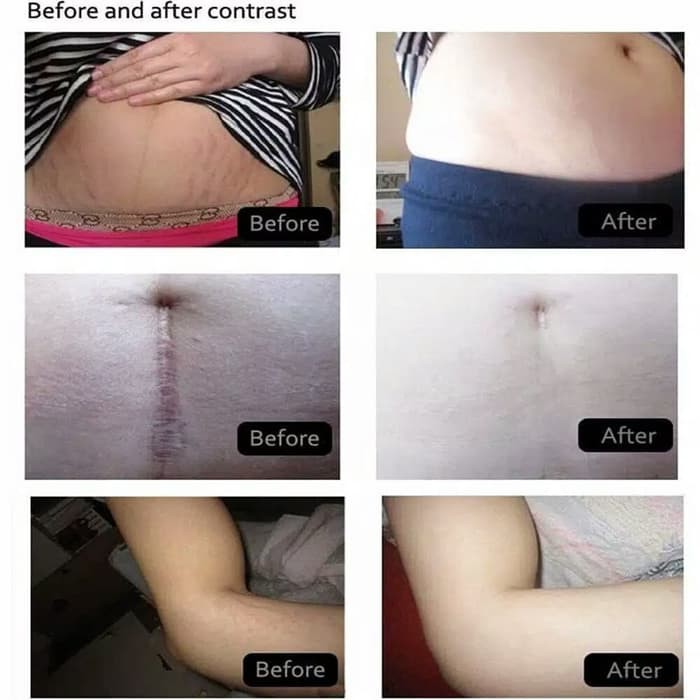 Meiyanqiong Krim Penghilang Bekas Luka Setelah Melahirkan Selulit