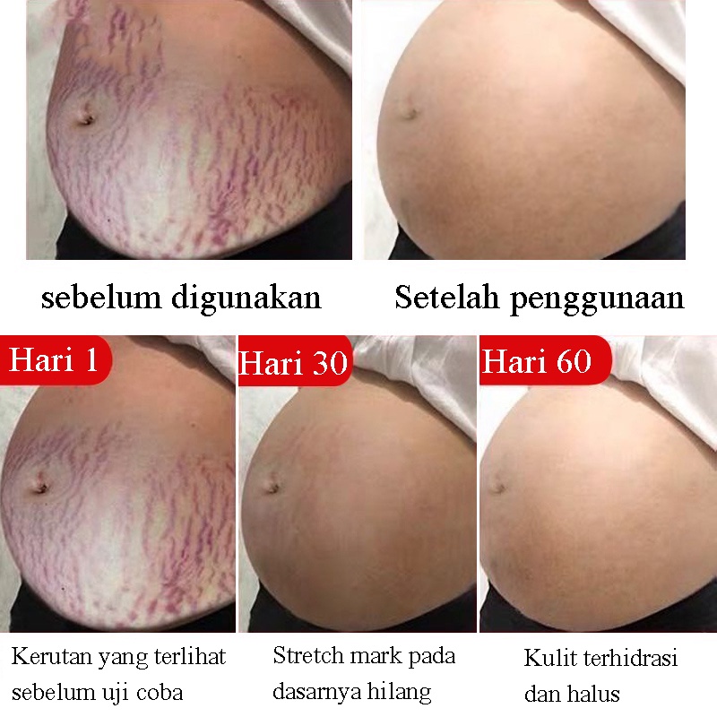 Stretch Mark Cream 45g / Penghilang Stretch Mark / Stretch Marks Pilihan Ibu / BPOM Penghilang Stretch Mark Ampuh / Mengencangkan kulit, mengembalikan kehalusan dan elastisitas