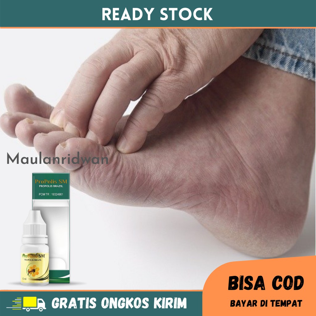 Obat Kutu Air, Kutu Air Di Kaki / Tangan, Tinea Pedas, Cacar Air, Infeksi Kulit, Obat Penghilang Kut