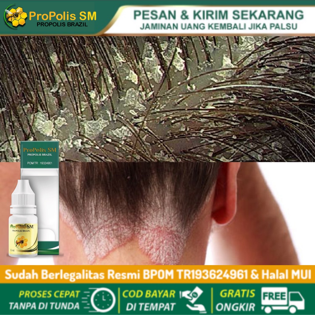 Obat Psoriasis Kulit Kepala, Obat Tetes Ketombe Berkerak, Kulit Kepala Kering dan Bersisik, Obat Ket