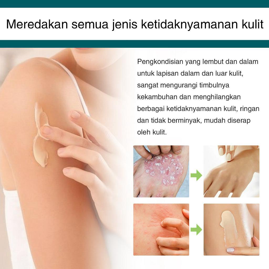 Obat kurap salep eksim salep gatal salep gatal selangkangan 30g Salep paling ampuh untuk gatal eksim/gatal kulit/eksim/gatal selangkangan/alergi kulit/kurap/gatal kaki