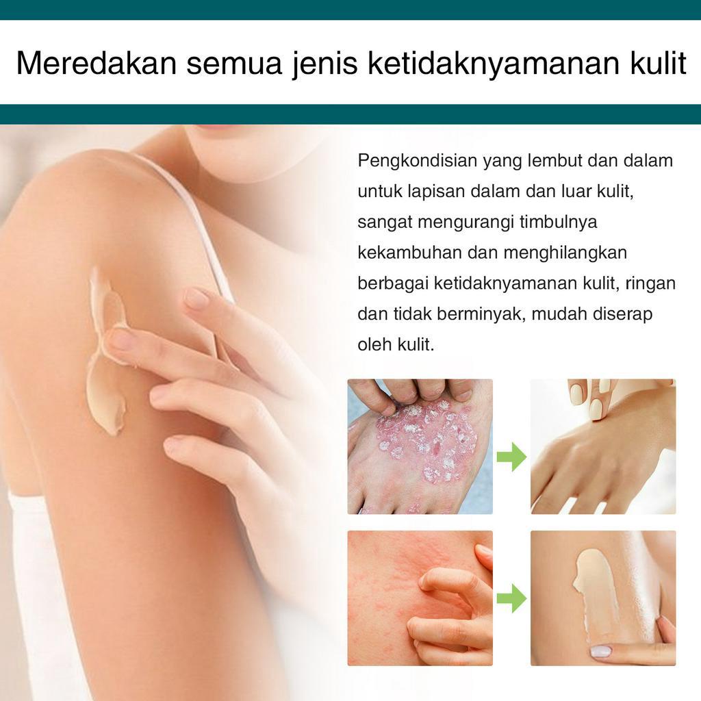 [100% Asli ] Obat gatal kulit Obat gatal paling ampuh Obat gatal selangkangan 30g Bakteriostasis herbal/Eksim membandel/Kulit gatal/Gatal di selangkangan/Krim Antipruritic Seluruh Tubuh