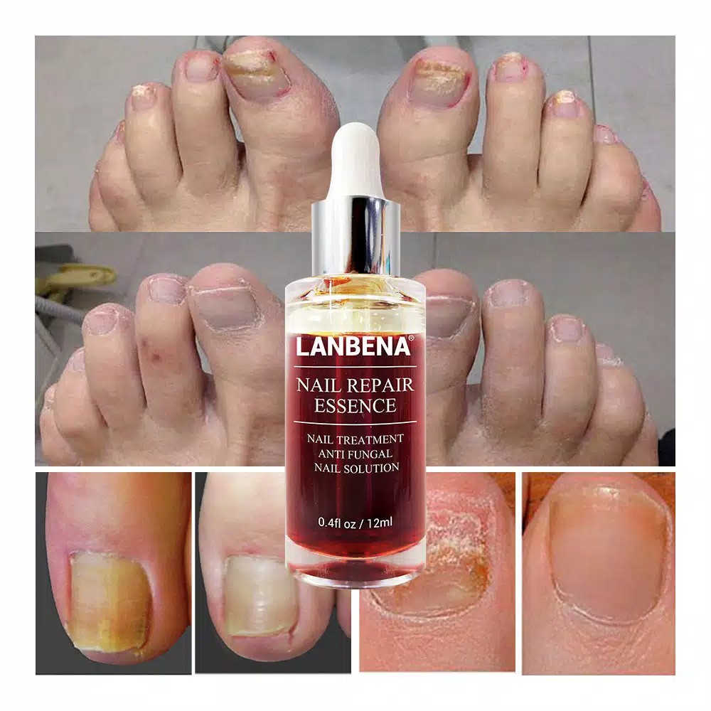 Lanbena Nail Repair Essence Oil Serum Nail Treatment