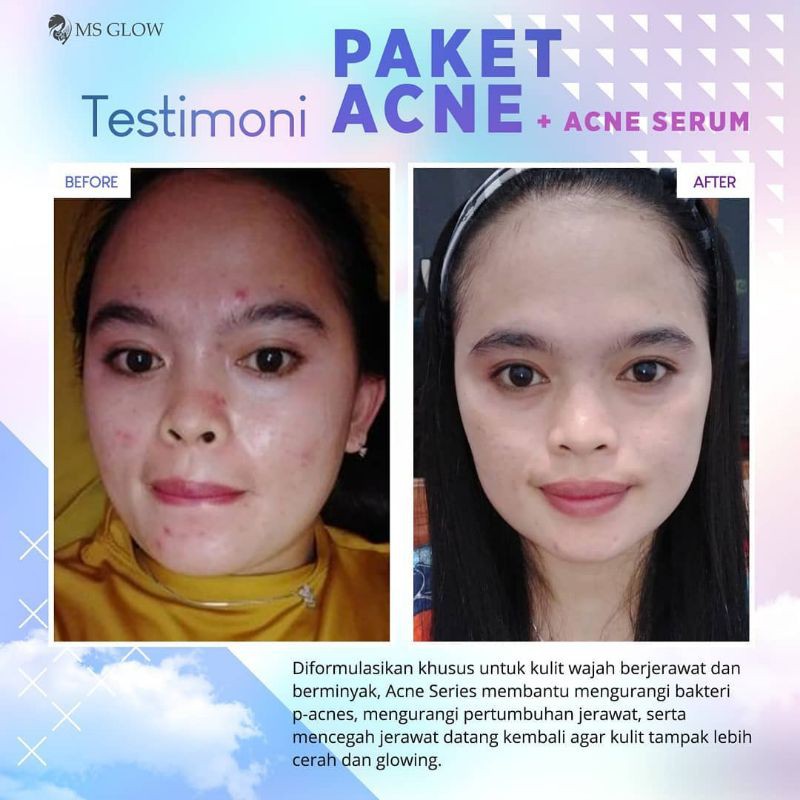 

PaketAcne